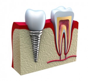 Dental implant